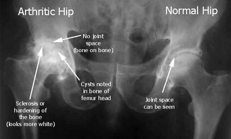Normal and diseased hip